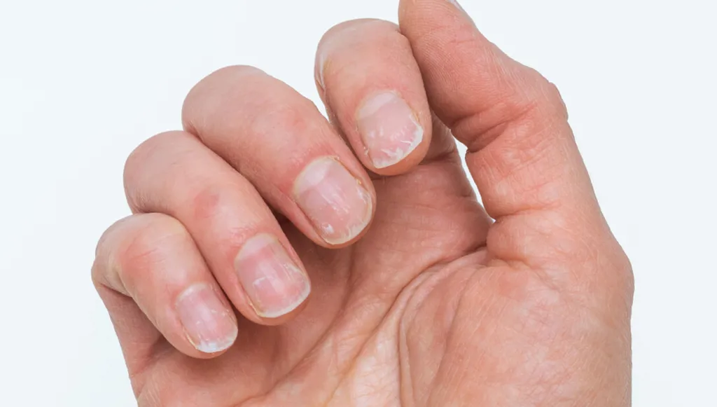 علامات في الأظافر واللسان تنذر بوجود مشكلة صحيّة طارئة علامات في الأظافر واللسان تنذر بوجود مشكلة صحيّة طارئة