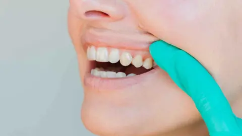 ابتكار علمي يسهم في إصلاح وتجديد مينا الأسنان