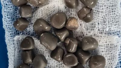 استخراج 58 حصوة من كلية مريض في مصر