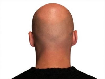 دواء لحب الشباب قد يعالج الصلع الوراثي